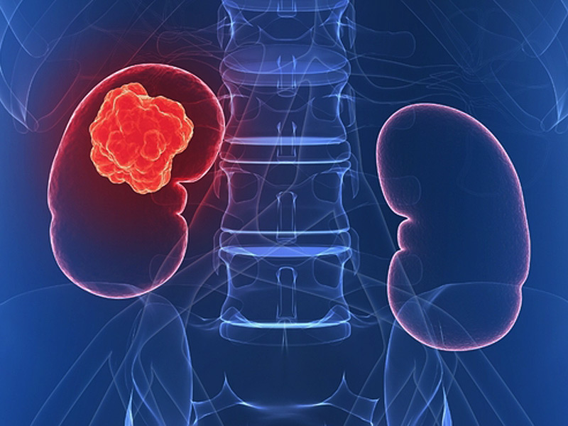 Facts about kidney cancer