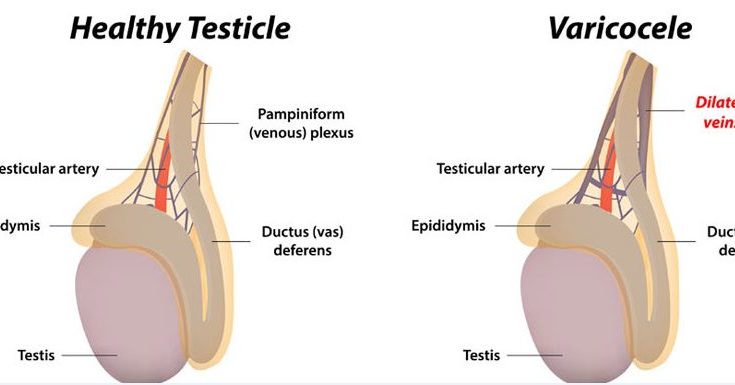  Varicocele  And Male Infertility Urology Department